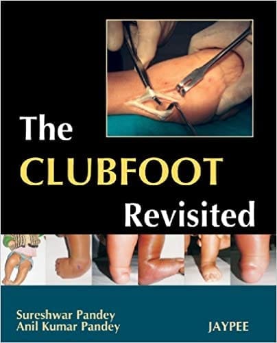 The Clubfoot Revisited