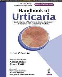 Handbook of Urticaria